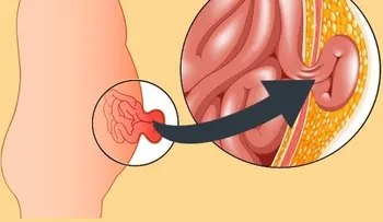 Diferencias entre hernia y desgarro abdominal