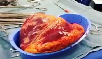 Impactante video: El corazón extirpado a un paciente late 25 minutos... ¡fuera del cuerpo!