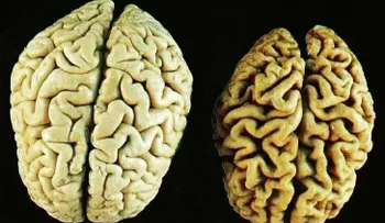 Cómo prevenir el deterioro del cerebro con estas 3 vitaminas beneficiosas