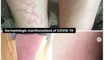 El coronavirus puede aparecer con erupciones en la piel, sobre todo en niños y jóvenes, según descubrimiento 