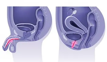 Uretritis: cómo se contrae y cuál es su tratamiento