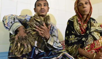 El 'hombre-árbol' de Bangladesh irá a cirugía para que le quiten sus 'ramas'