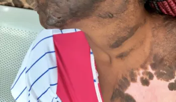 Haitiana denuncia que otra mujer le lanzó aceite caliente en Santo Domingo Oeste