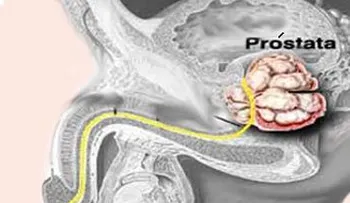 Problemas prostasticos