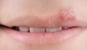 Si tienes menos de 50 años, es probable que tengas herpes