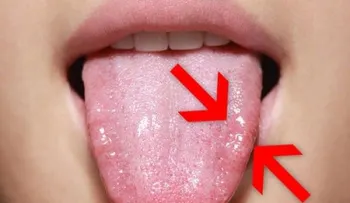 9 remedios naturales para tratar la candidiasis