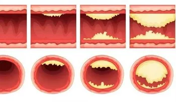 3 ingredientes que destapan las arterias y protegen al corazón naturalmente!