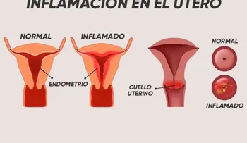  Remedios para la inflamación en el útero