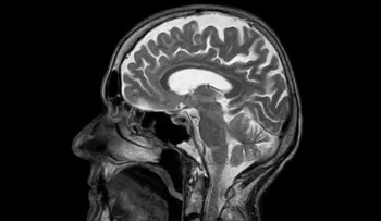 Descubren 13 errores genéticos que aumentan el riesgo de cáncer cerebral