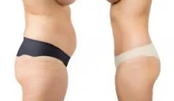 Liposucción ambulatoria: un procedimiento rápido y efectivo