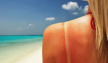 ¿Se te pasó la mano con el sol? Aquí tienes la solución