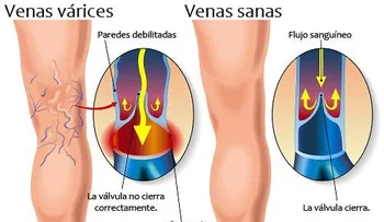 Remedios para varices: romero, hamamelis, caminar 30 mitutos y baños de agua fría y caliente