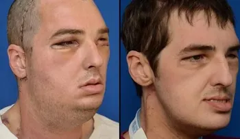 El hombre que encontró un rostro por un milagro médico, dice que se siente "normal" 