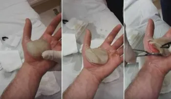 Tenía una ampolla en la mano, y cuando el doctor la explotó mira lo que encontró (VIDEO)