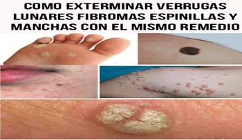 De esta manera podrás exterminar verrugas, lunares, fibromas, espinillas y manchas con el mismo remedio
