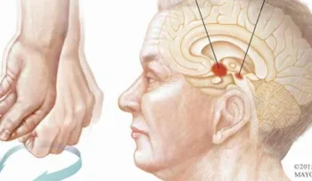 Es difícil predecir la velocidad de avance de la enfermedad de Parkinson