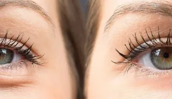 La hinchazón debajo de los ojos, cómo tratarla