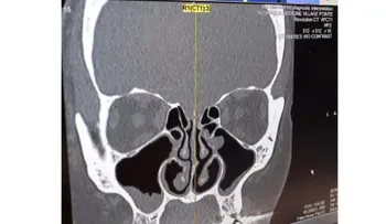 Ella pensó que tenía una fuerte gripe, pero era líquido saliendo de su cerebro