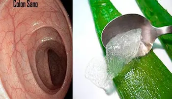 Esta es la forma correcta de preparar gel de aloe vera para una limpieza de colon