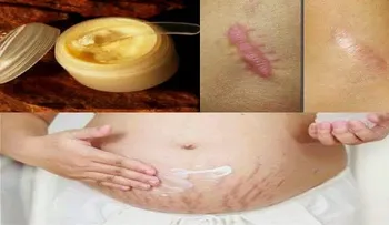 Si quieres eliminar las cicatrices en dos semanas prueba esta crema 