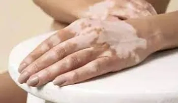 Revelan tratamiento para el vitiligo, Melagenina Plus, desarrollado en Cuba