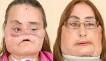 Era normal como cualquier persona, pero gracias a DIOS puede respirar y sigue mejorando