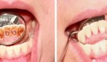 6 tips para controlar acumulación del sarro