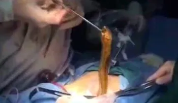 En una operación impactante un médico saca una angila del estómago de un paciente, que se la metió por el ano