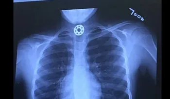Una niña se asfixió con una pieza de un fidget spinner