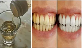 Esta es la única receta para eliminar el sarro dental