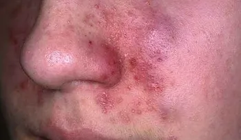 Tratamiento natural para la dermatitis seborreica