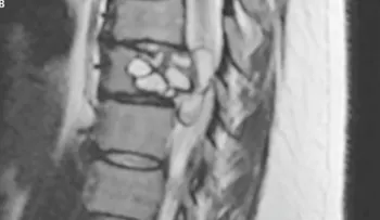 El hormigueo en las piernas de esta mujer resultó ser un gusano parásito en la espalda