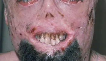Foto: Enfermedad de Vampiro: Terror al sol