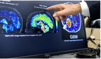 Latinos en EE.UU. hallan biomarcador contra Alzheimer