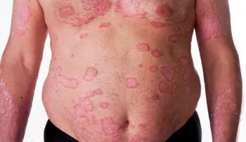 La obesidad puede empeorar la psoriasis