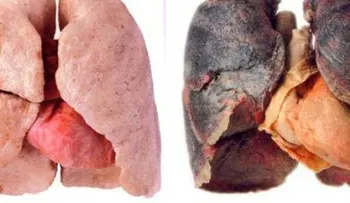 Síntomas de cáncer de pulmón que no debes ignorar 