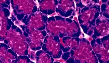 Un nuevo test para detectar precozmente cáncer de páncreas