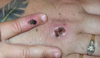 Registran primeros casos de una extraña infección llamada viruela del simio en Reino Unido