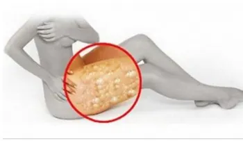 Mira como el vinagre ayuda a desaparecer la celulitis magicamente