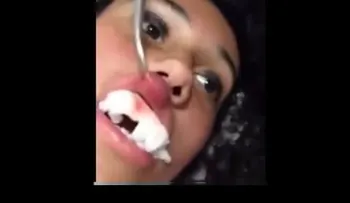Fue al médico por una hinchazón en el labio...y le sacan algo increíble (VIDEO)