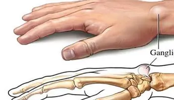 Si tienes bultos en la muñeca, descubre las 5 causas más frecuentes y cómo solucionarlo!