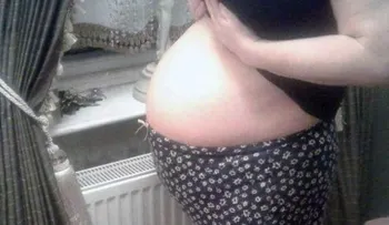 Una mujer tuvo 3 años su abdomen inflamado; parecía un embarazo