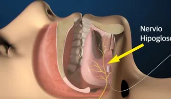 ¿Roncas mucho? Quizá sufres apnea del sueño