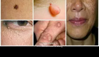 Desaparece tus verrugas, lunares, espinillas y manchas de edad para siempre de manera natural (VIDEO) 