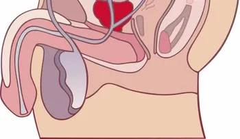 Los sintomas de una prostata enferma