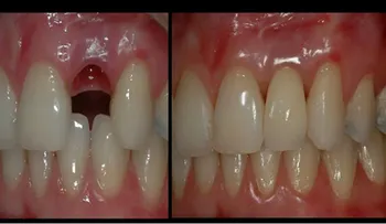 Dile adiós a los implantes dentales. Cómo hacer crecer un diente en 2 meses