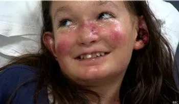La niña cuya piel nunca se cura