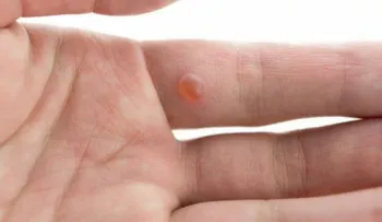 Cómo eliminar las verrugas de la piel sin dejar cicatriz