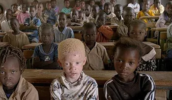 La caza de los niños albinos en África, víctimas de la magia y la superstición