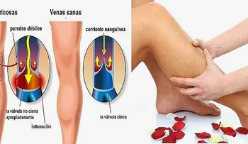 MI amigo dermatólogo me enseñó este remedio para las arañitas o várices